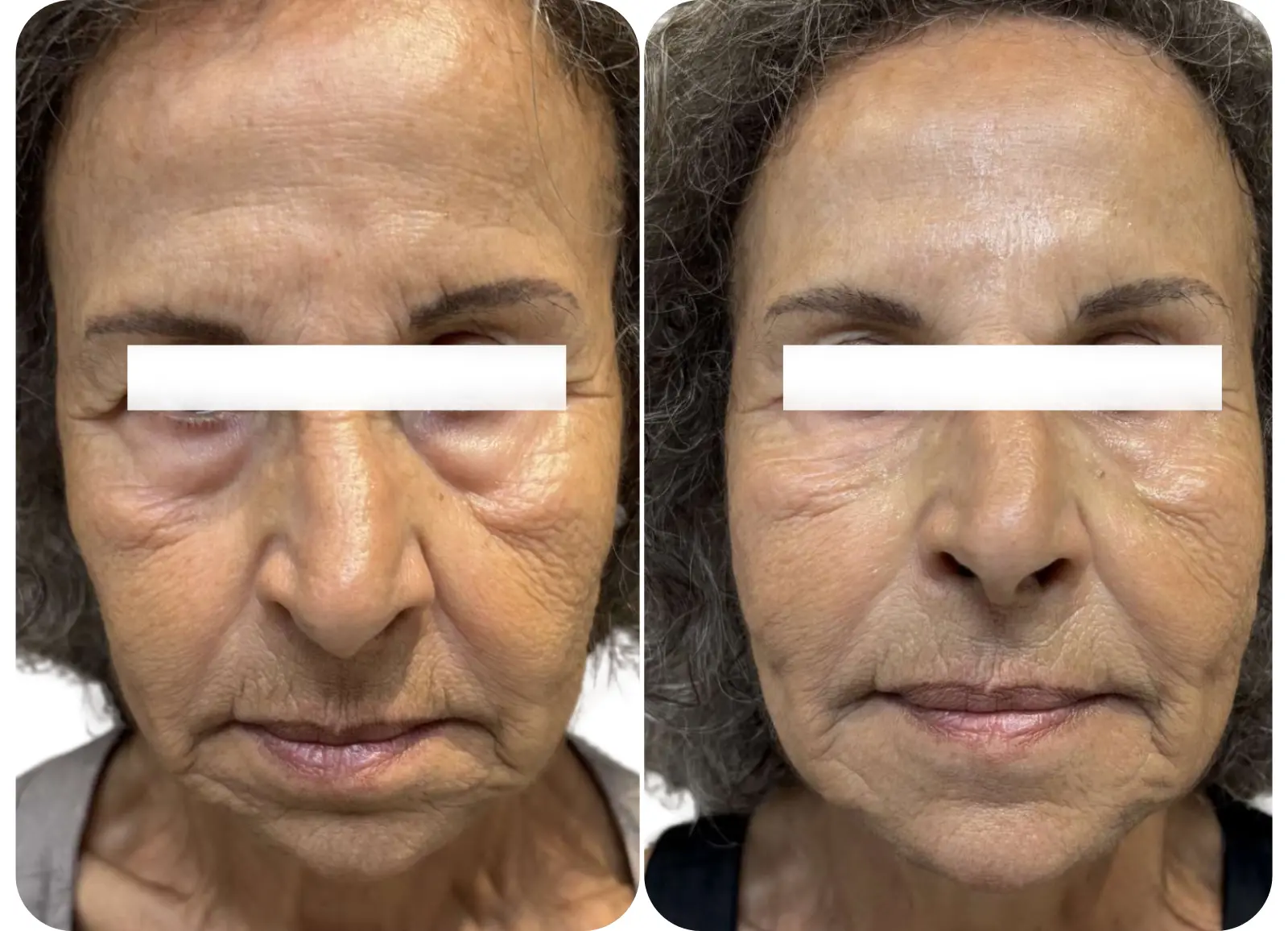 AVANT APRÈS INJECTIONS D'ACIDE HYALURONIQUE DANS LA VALLÉES DES LARMES ET LES SILLONS NASOGÉNIENS.