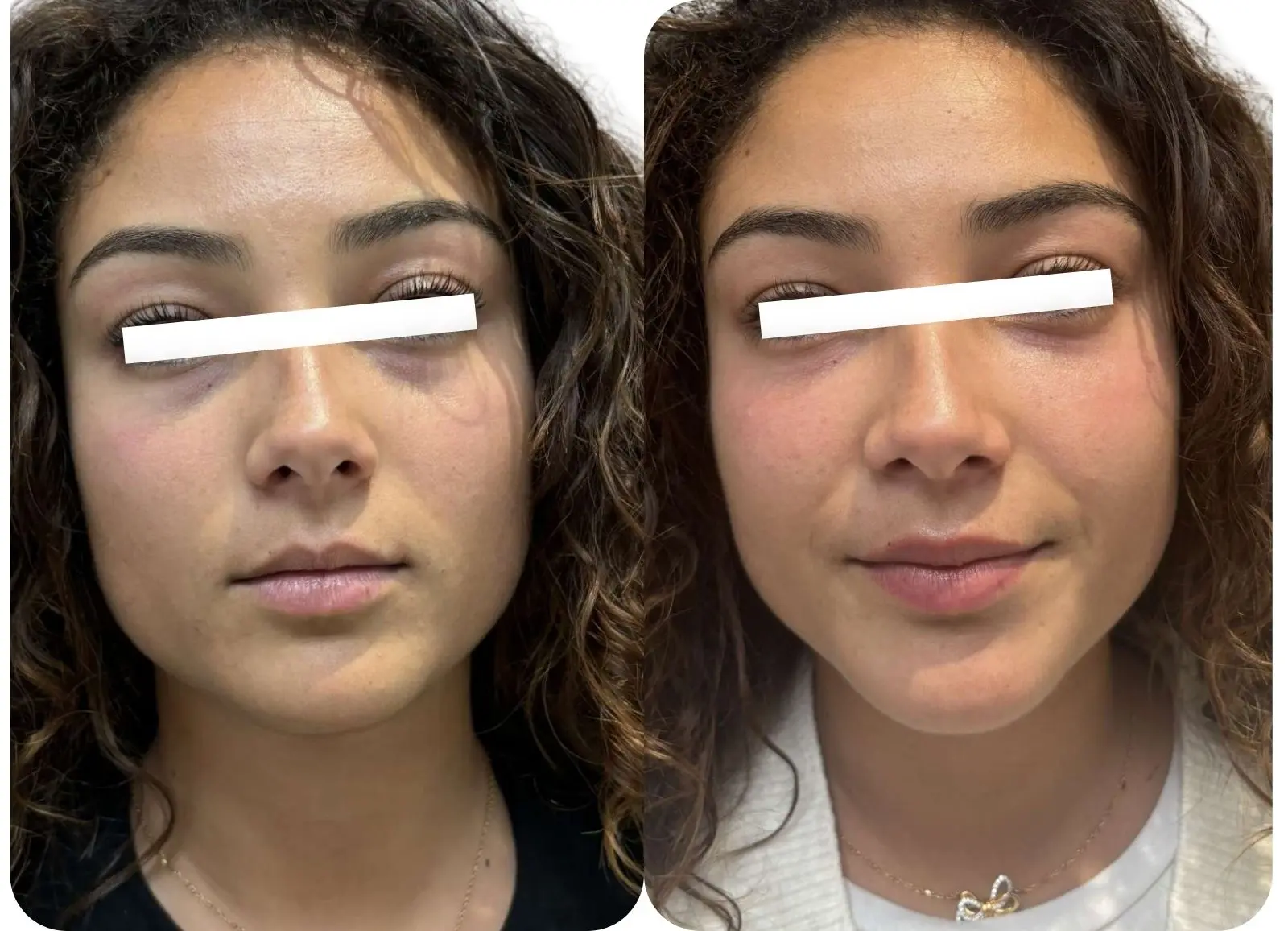 INJECTIONS D'ACIDE HYALURONIQUE - CERNES