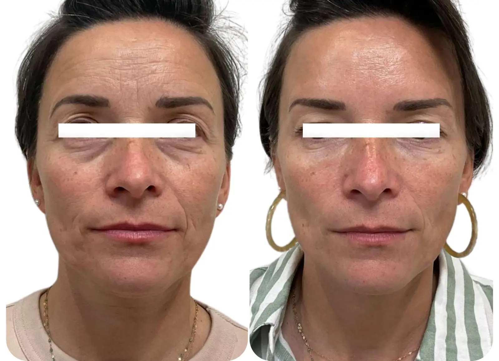 INJECTIONS D'ACIDE HYALURONIQUE - CERNES