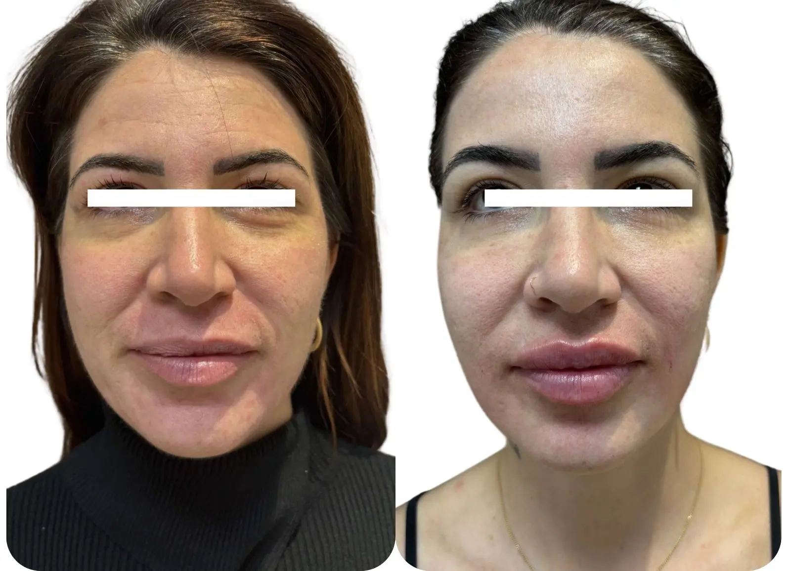 Acide hyaluronique - lèvres