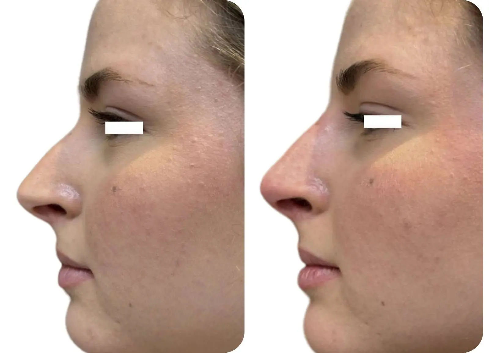 INJECTIONS D'ACIDE HYALURONIQUE - RHINOPLASTIE MÉDICALE