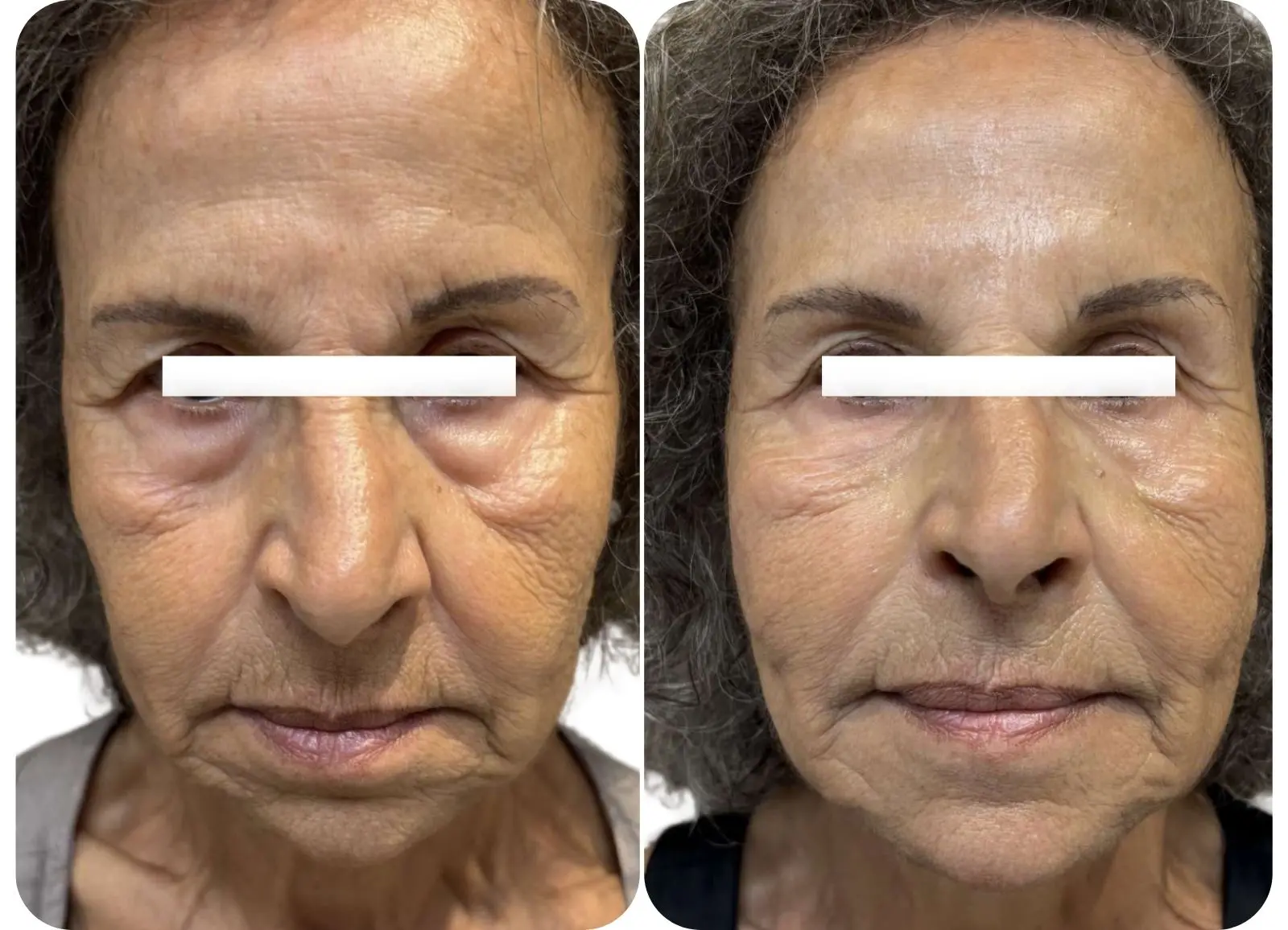 INJECTIONS D'ACIDE HYALURONIQUE - VALLÉE DES LARMES ET SILLONS NASOGÉNIENS