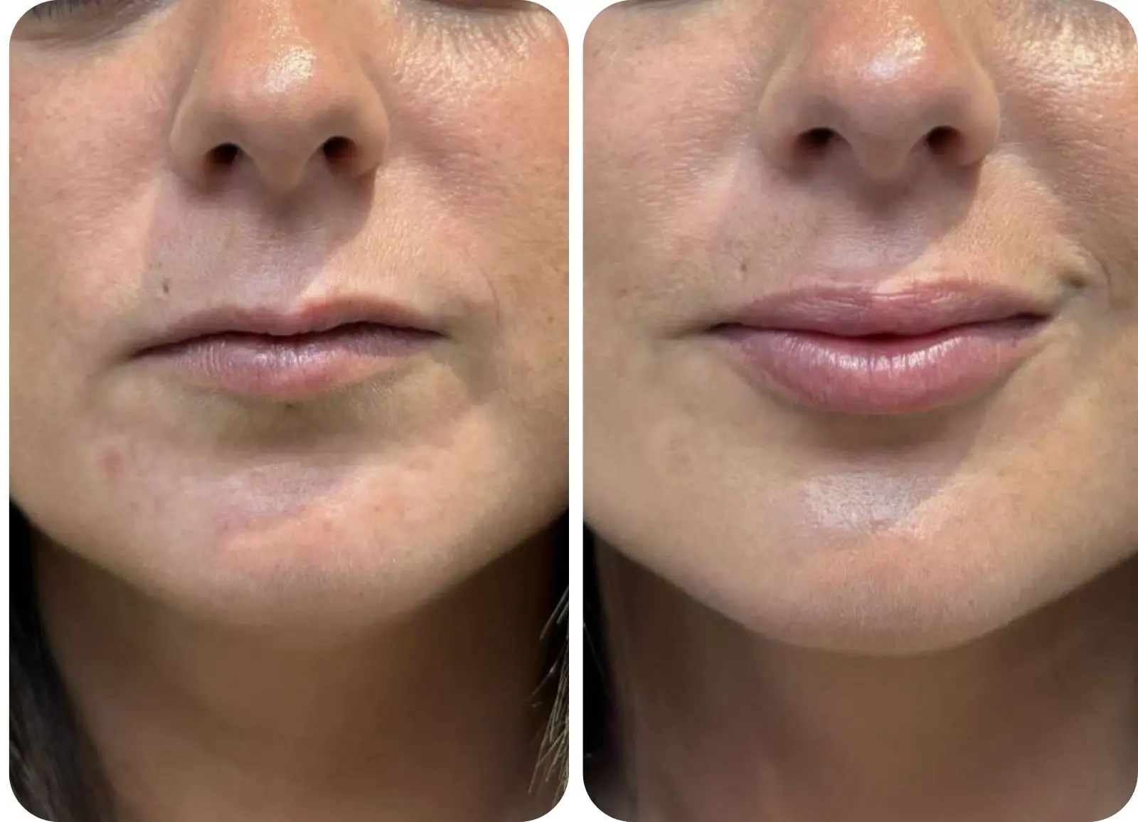 Avant/après injection d'acide hyaluronique dans les lèvres.